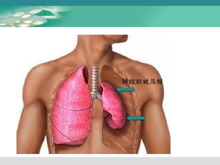 护理查房：自发性气胸的护理_第3页