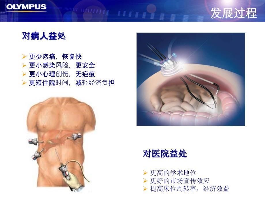 外科新技术奥林巴斯_第5页