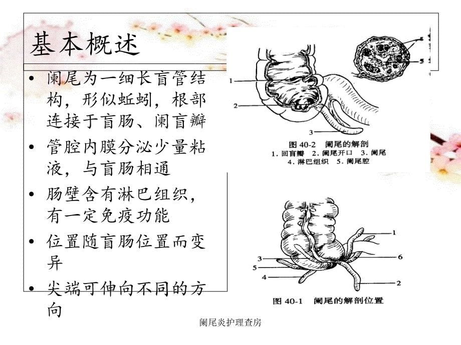 阑尾炎护理查房_第5页