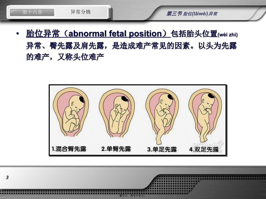 异常分娩-胎位异常课件_第3页