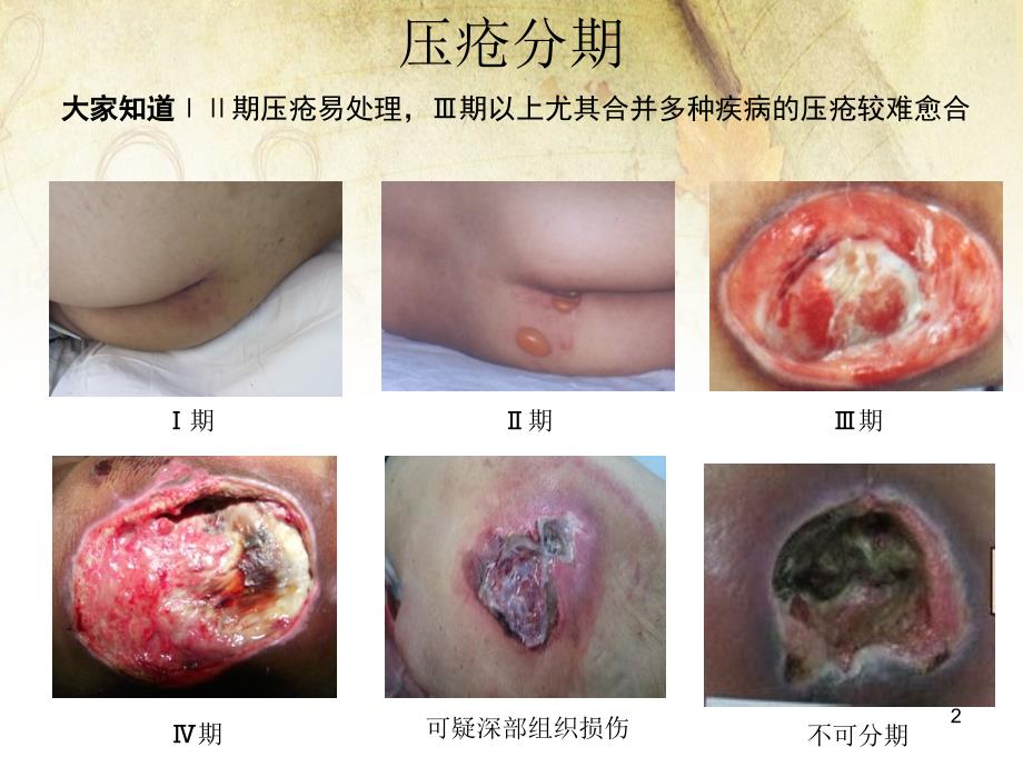 推荐精选压疮个案护理查房_第2页