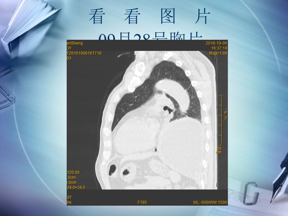 肺脓肿病例讨论(模板)_第3页