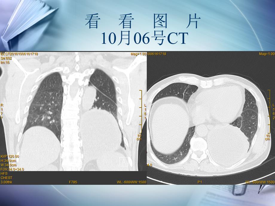 肺脓肿病例讨论(模板)_第4页