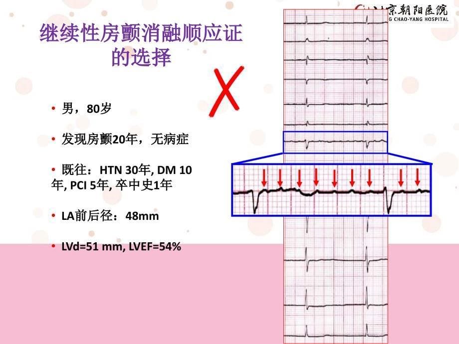 如何术前识别持续房颤导管消融治疗的无低反应者ppt课件_第5页