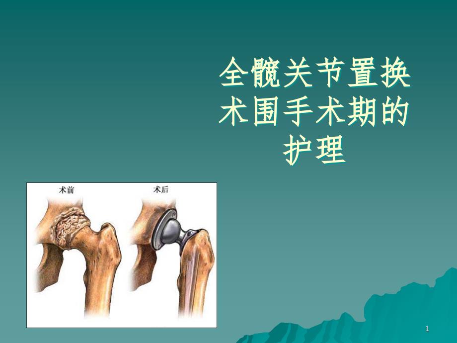 髋关节置换术围手术期的护理PPT精选文档_第1页