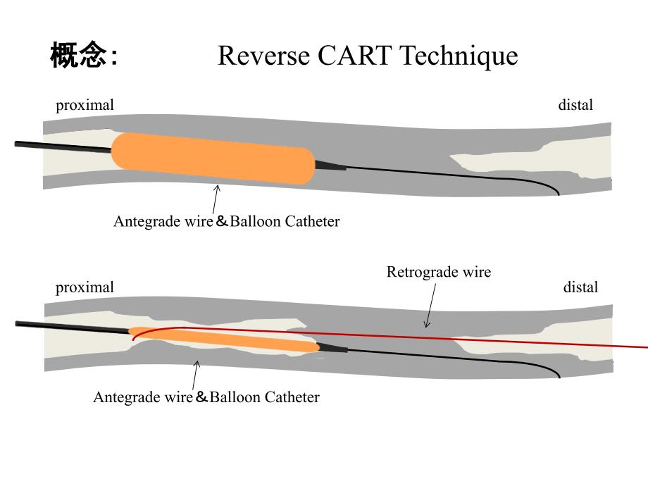 ct病变：反向cart技术临床应用金恩泽_第4页