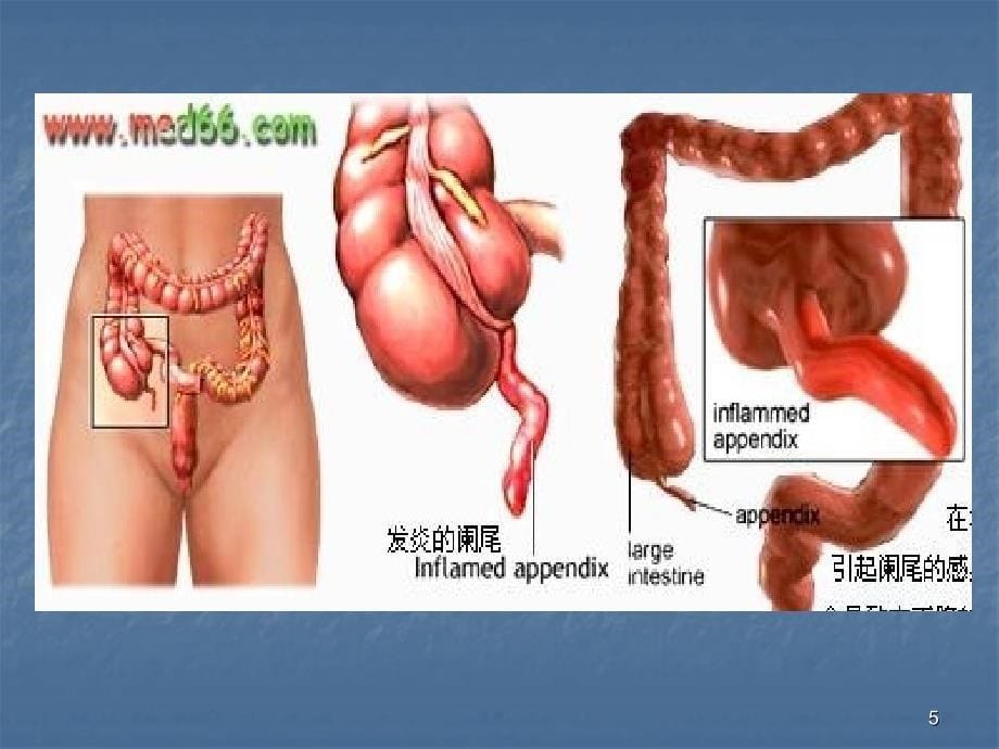 阑尾炎病人的护理_第5页