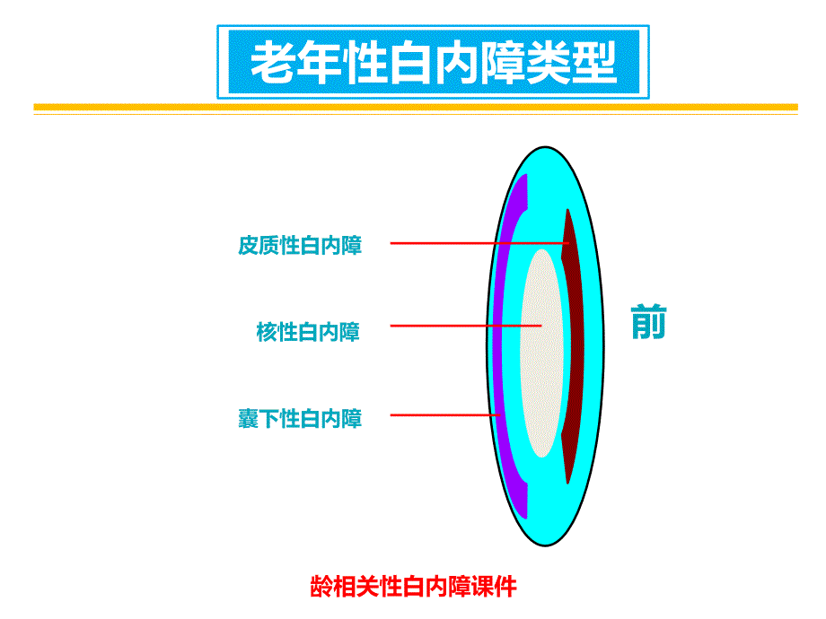 龄相关性白内障课件_第3页