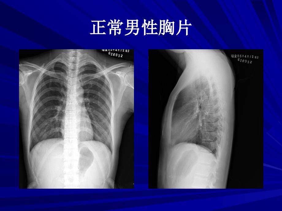 胸部X线基础读片.ppt_第2页