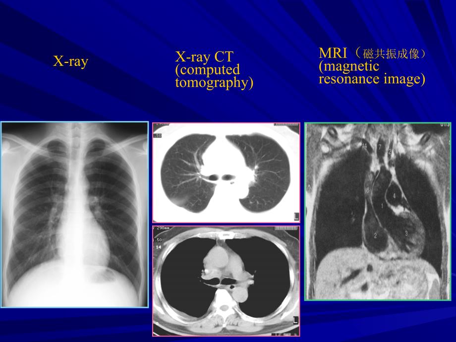 胸部X线基础读片.ppt_第4页