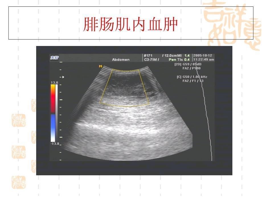 浅表肿物的超声诊断思路_第5页