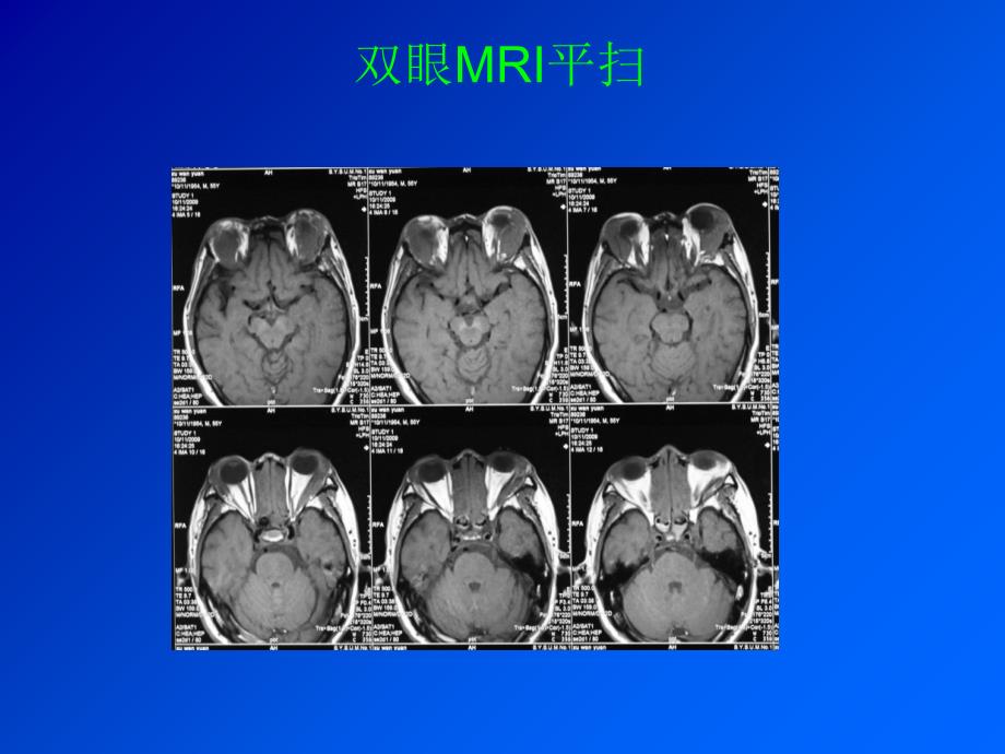 风湿科病例讨论炎性假瘤_第4页