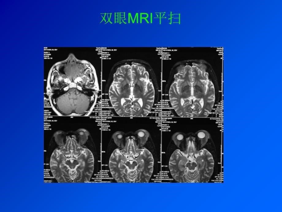 风湿科病例讨论炎性假瘤_第5页