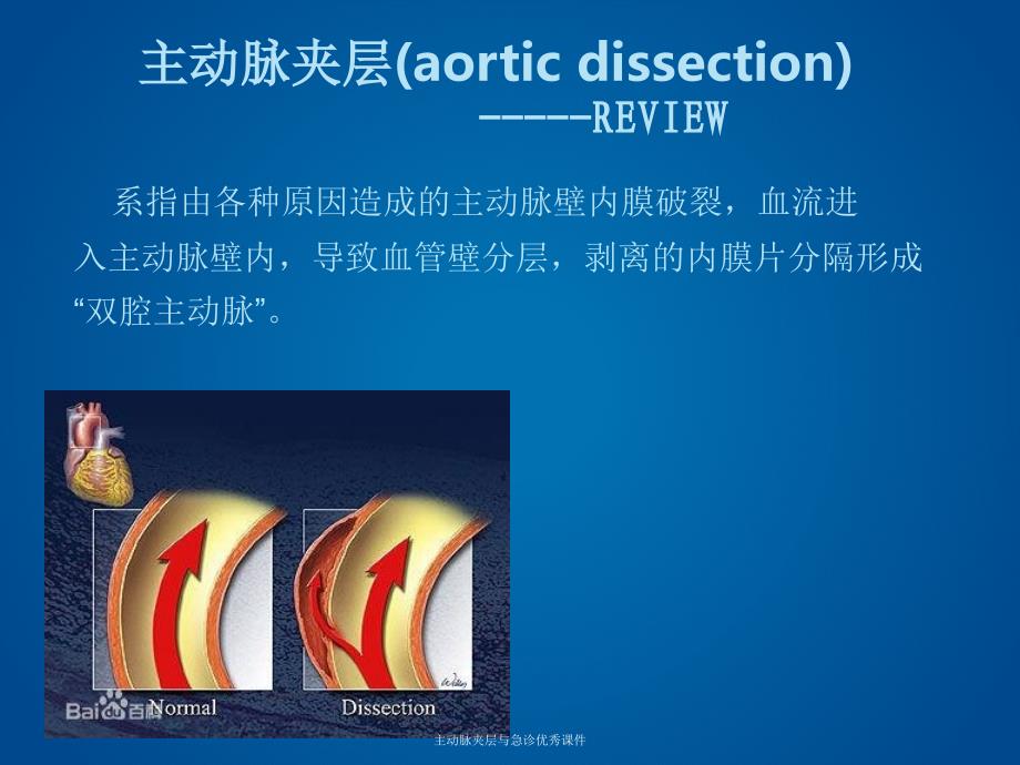 主动脉夹层与急诊优秀课件_第3页