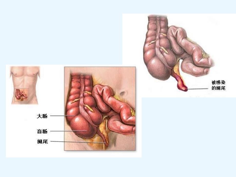 腹腔镜阑尾切除术_第2页