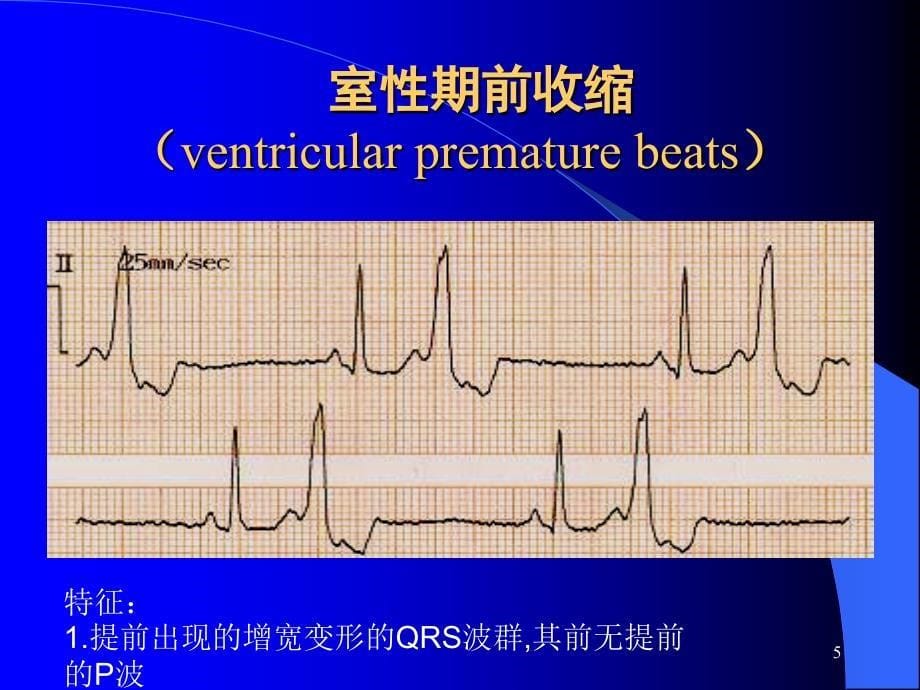 心律失常诊断及治疗 ppt课件_第5页