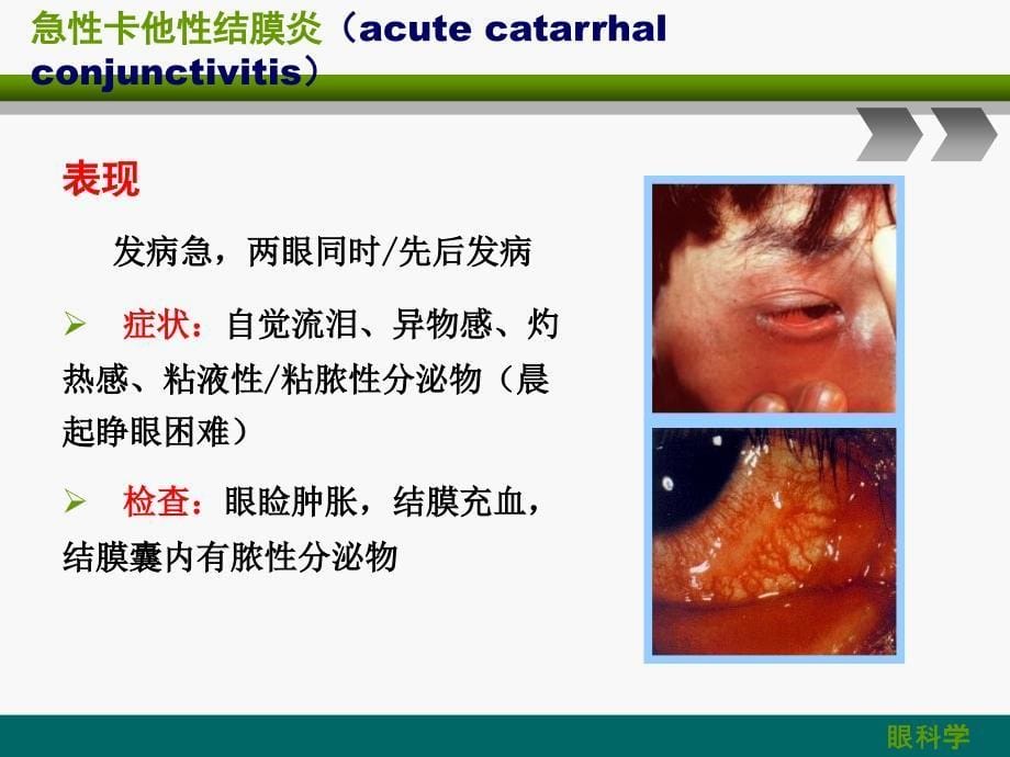 结膜病角膜病白内障_第5页