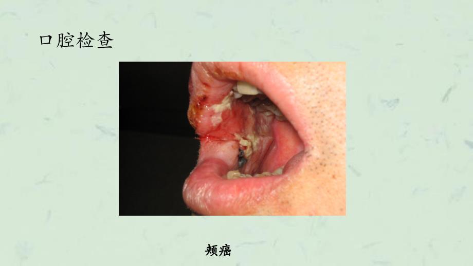 口腔颌面外科临床检查课件_第4页