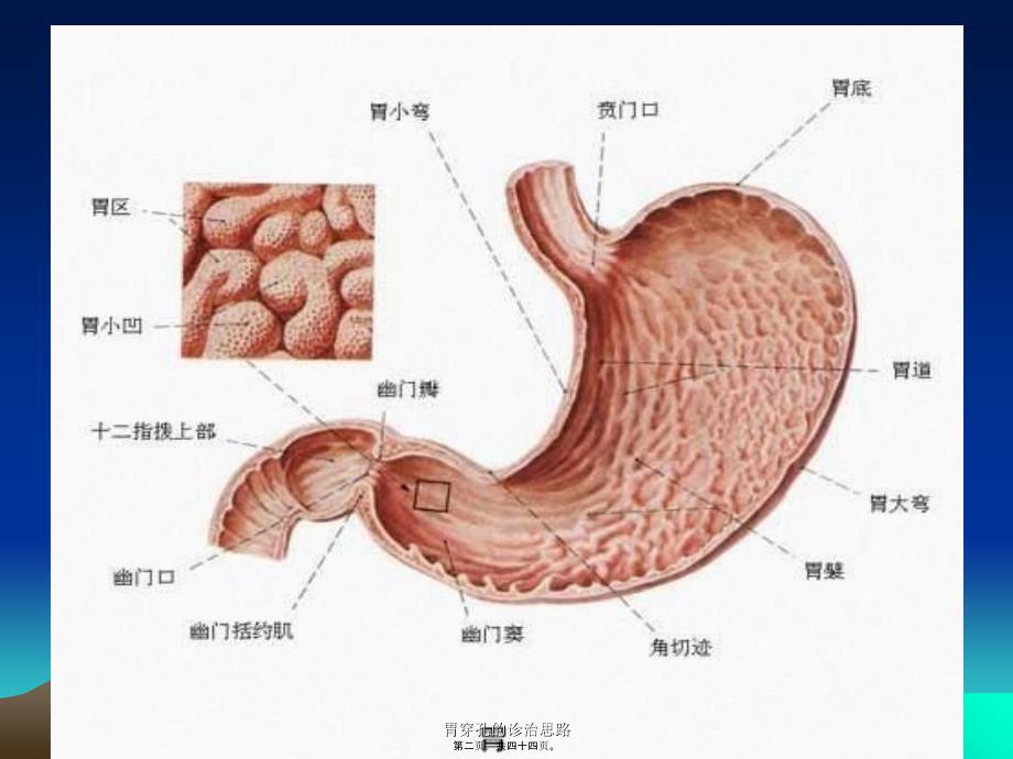 胃穿孔的诊治思路课件_第2页