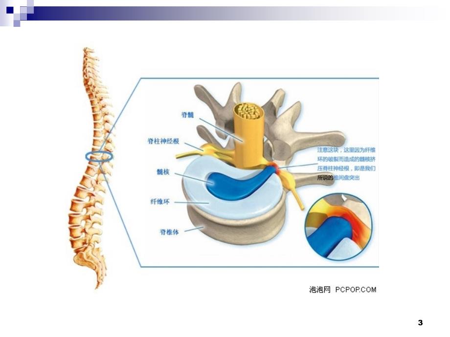 腰椎间盘突出的影像诊断课件.ppt_第3页