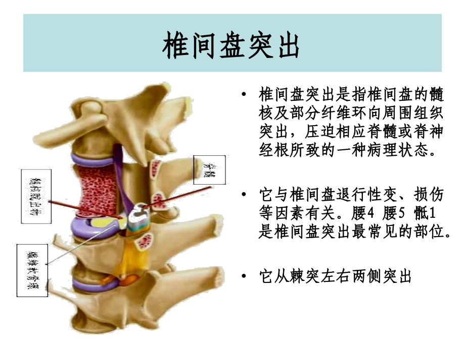 腰椎间盘突出与腰肌劳损运动康复_第3页