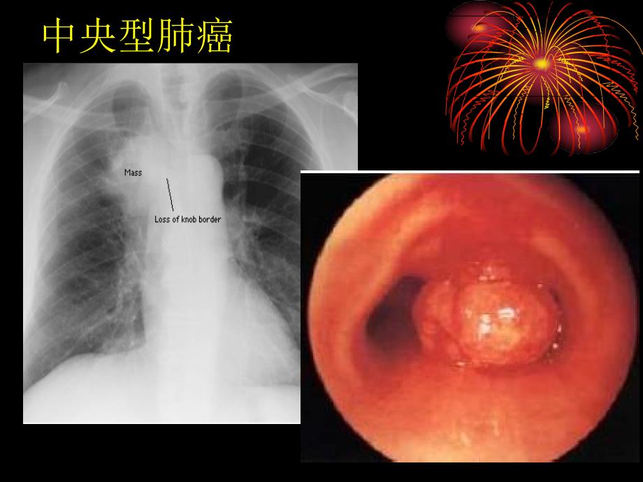 支气管镜检查的适应症_第4页