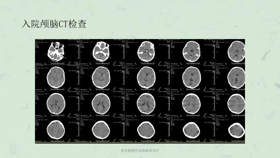 急性脑梗死动脉取栓治疗课件_第3页