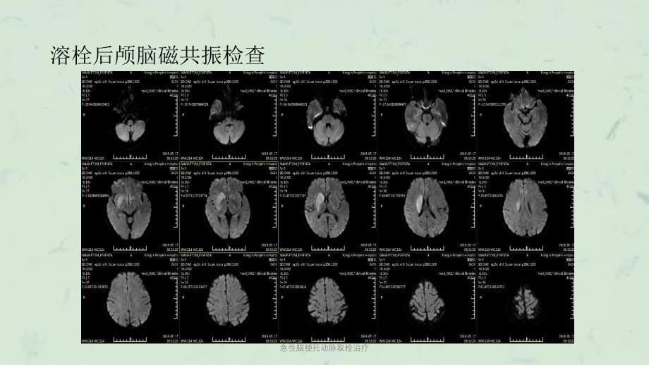 急性脑梗死动脉取栓治疗课件_第5页