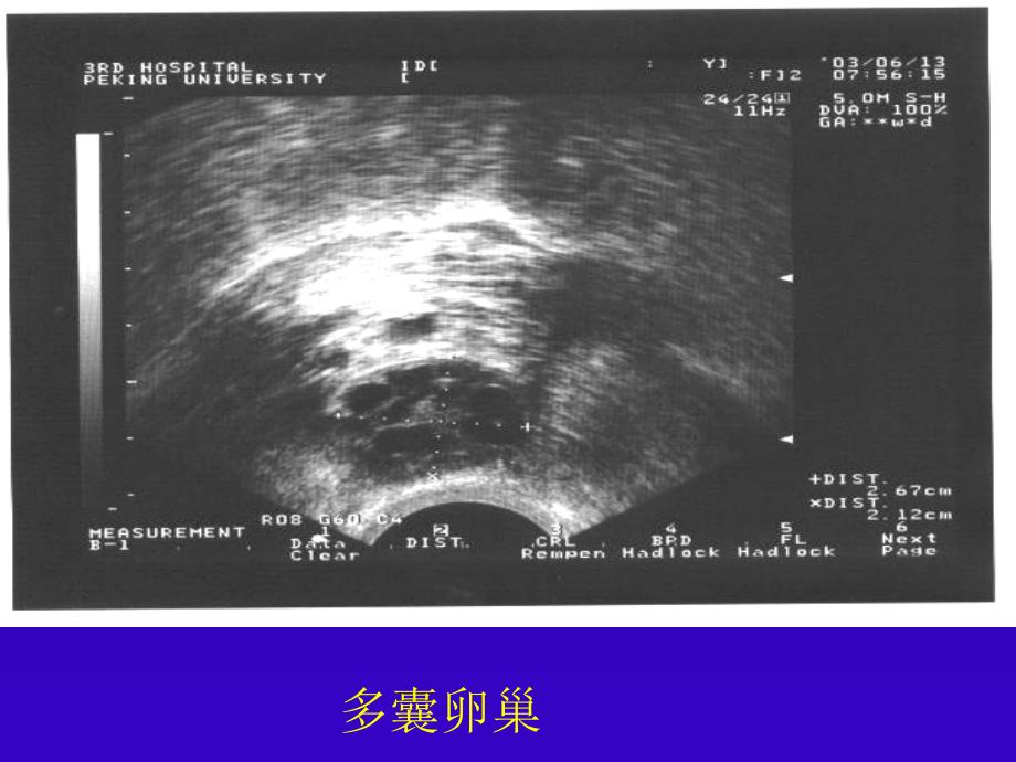 B超监测卵泡发育ppt课件_第4页