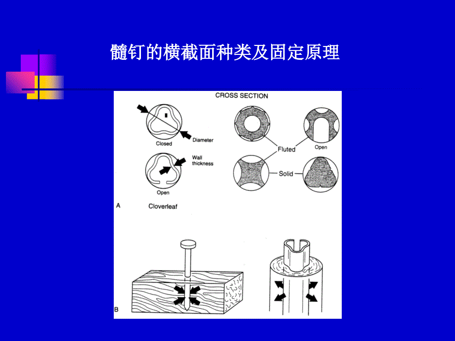 四肢长骨骨折髓钉固定原理及原则_第4页