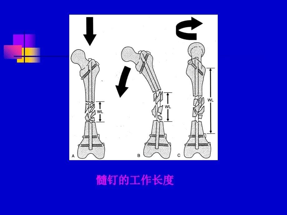 四肢长骨骨折髓钉固定原理及原则_第5页