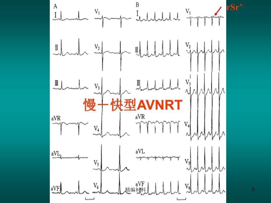 窄QRS波心动过速的诊断与鉴别诊断详细（深度分析）_第5页