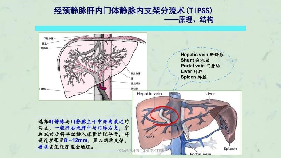 经颈静脉肝内门体分流术TIPS课件_第5页