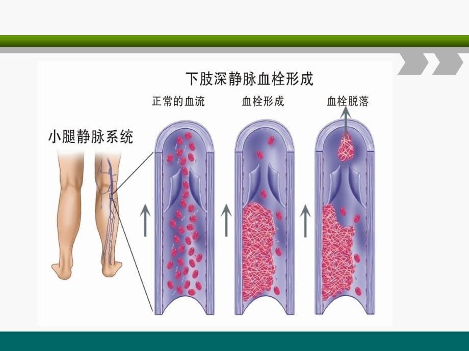 下肢深静脉血栓的护理查房ppt课件_第5页