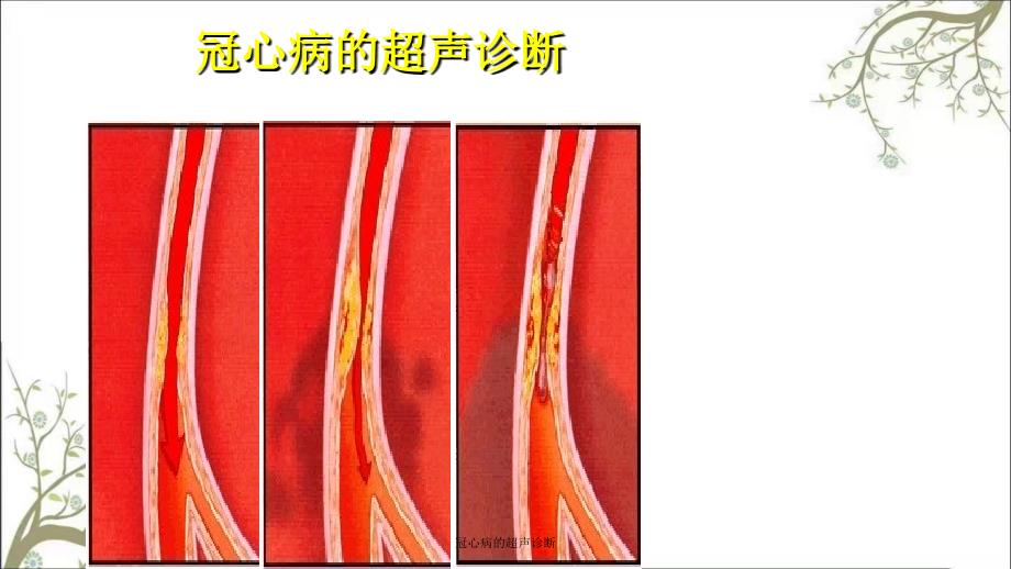 冠心病的超声诊断课件_第1页