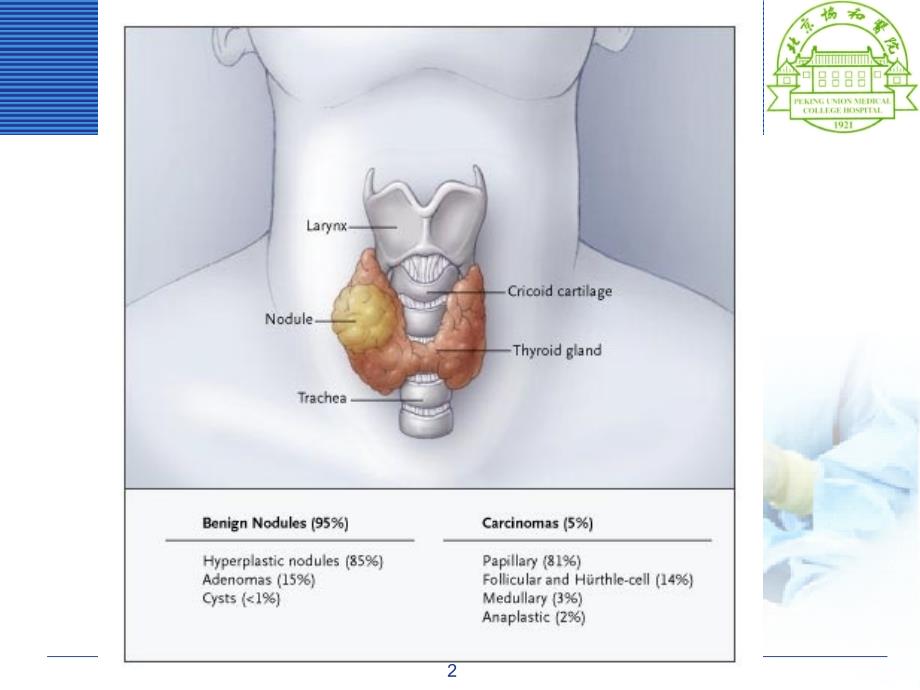 甲状腺髓样癌的治疗和护理PPT课件_第2页