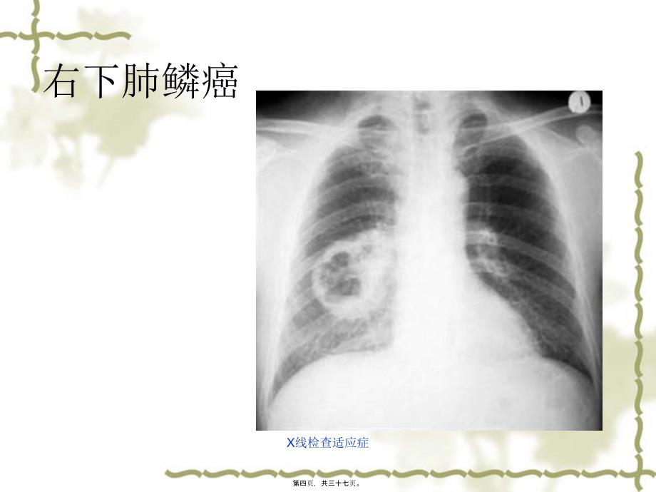 X线检查适应症课件_第4页