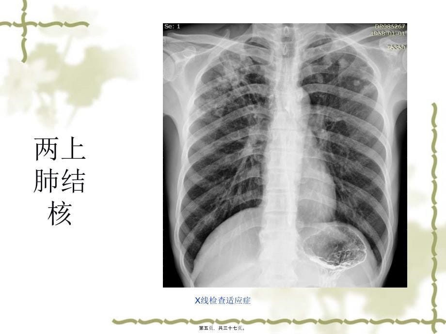 X线检查适应症课件_第5页