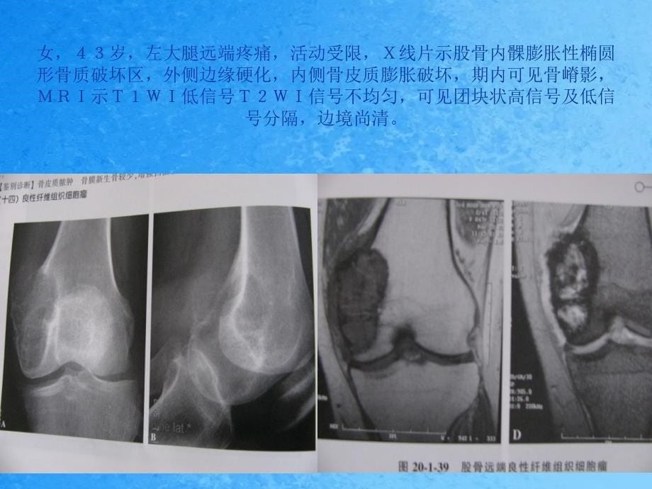 骨良性纤维组织细胞瘤诊断与鉴别ppt课件_第5页