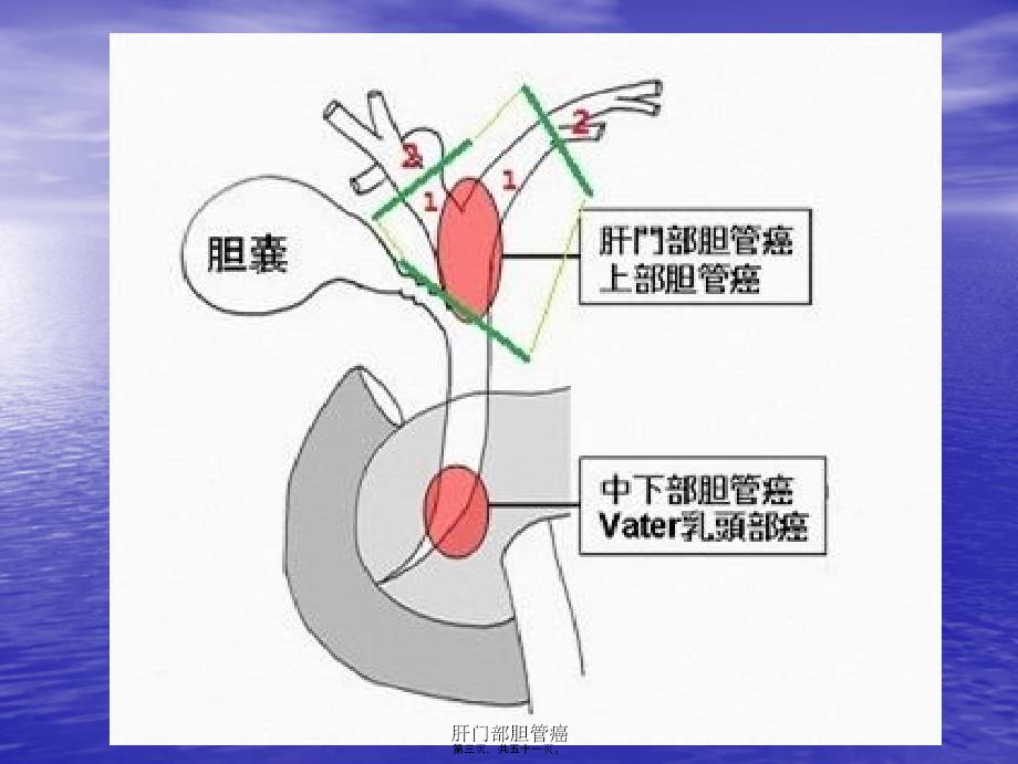 肝门部胆管癌课件_第3页