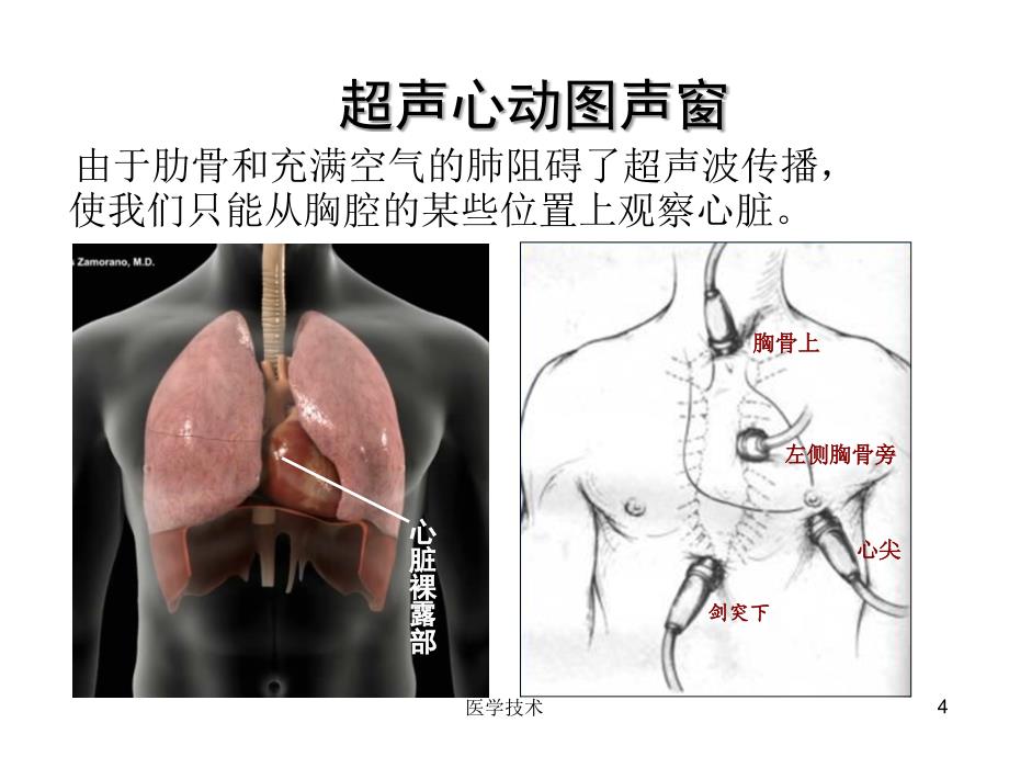 超声心动图常用切面的打法图解医学技术_第4页