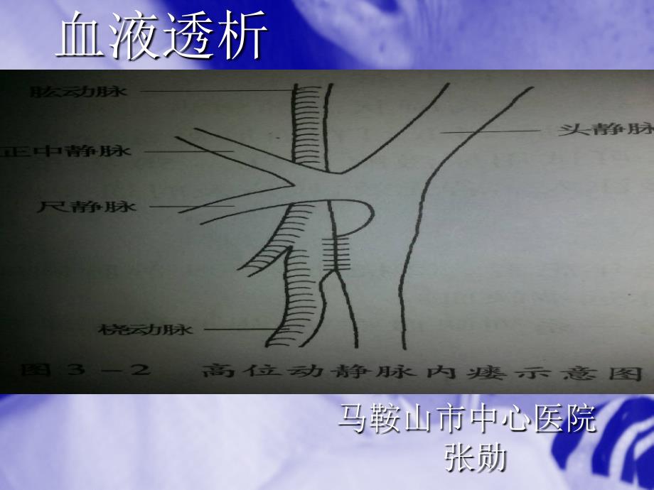 什么是血液透析课件_第1页