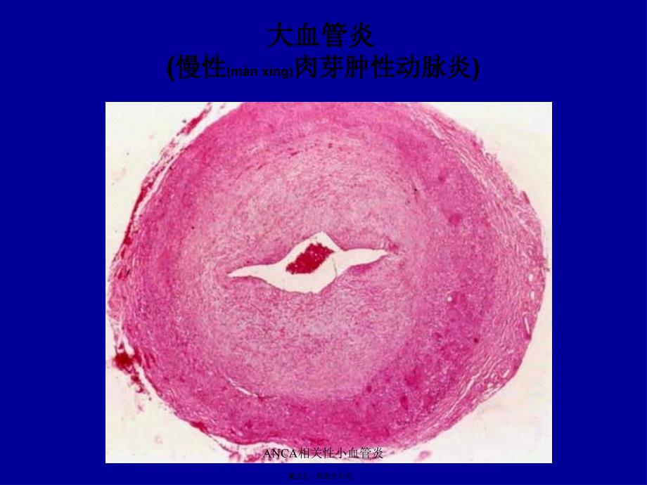 ANCA相关性小血管炎课件_第3页