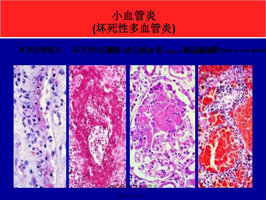 ANCA相关性小血管炎课件_第4页