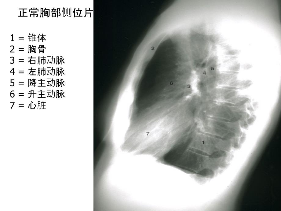 胸部X线图解胸部后前位平片图解文档资料_第1页