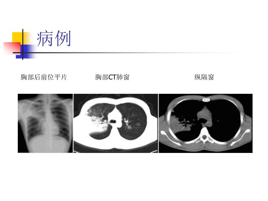 大叶性肺炎的影像诊断_第3页