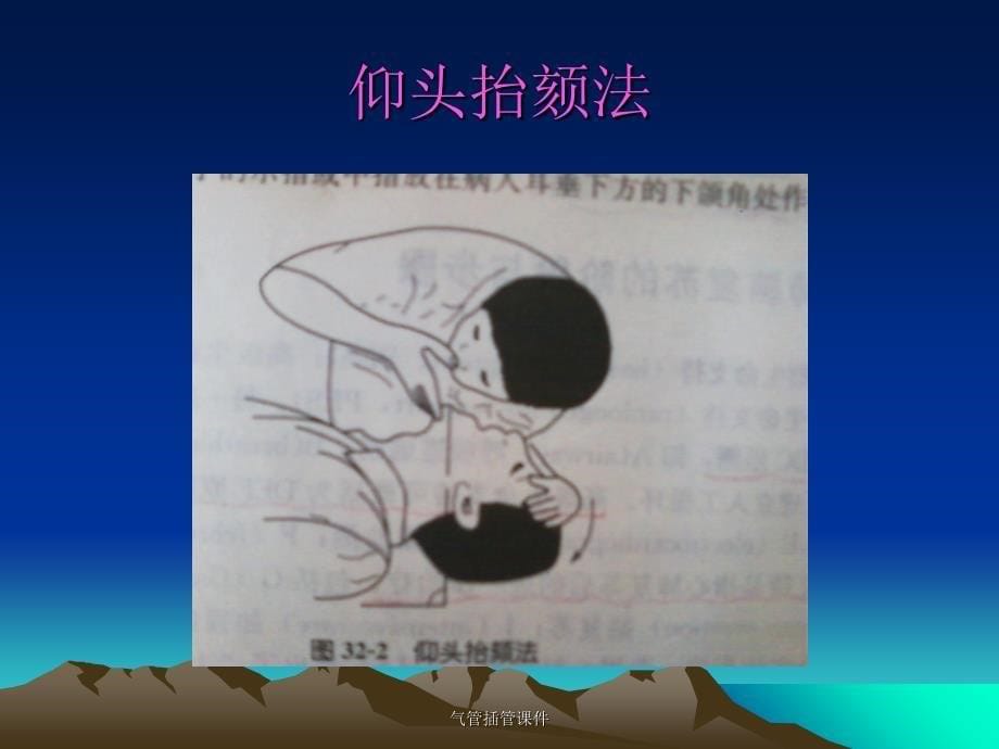 气管插管课件_第5页