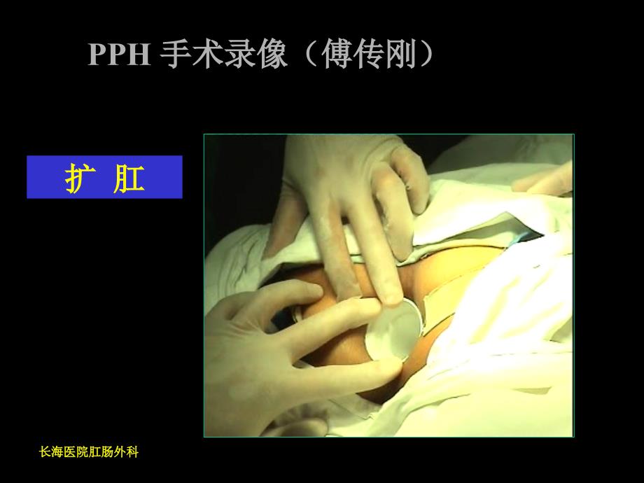 最新PPH手术治疗环形脱垂性内痔精选PPT文档_第3页