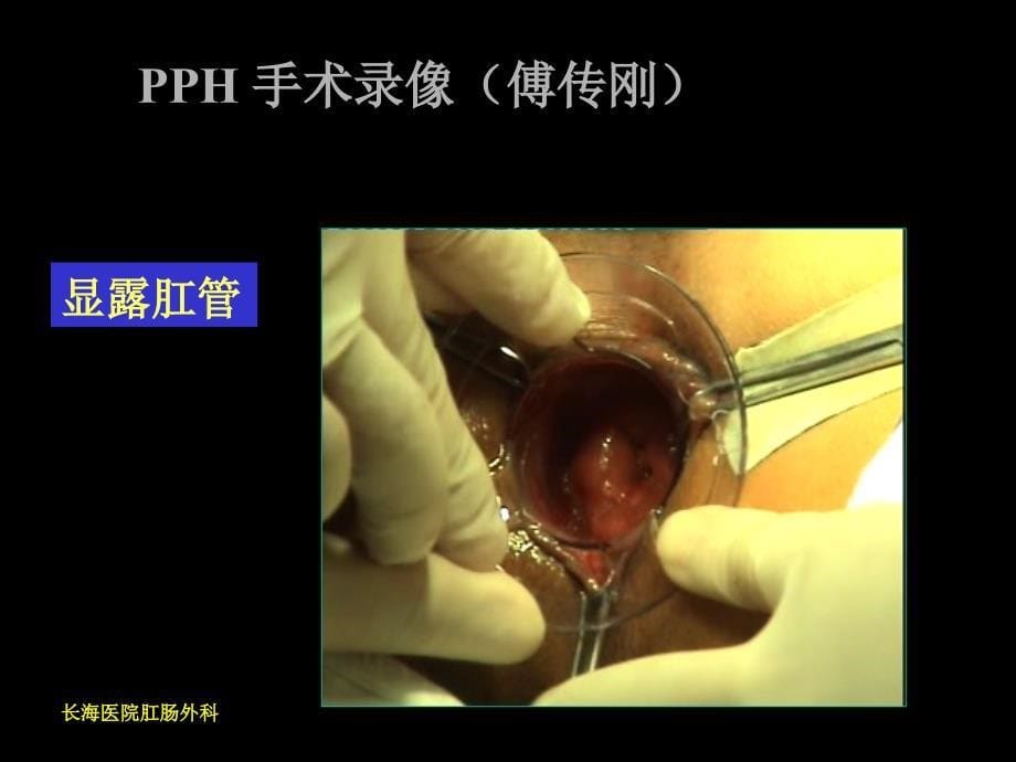 最新PPH手术治疗环形脱垂性内痔精选PPT文档_第5页