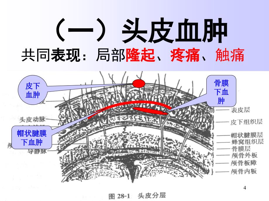 重度颅脑损伤ppt课件_第4页